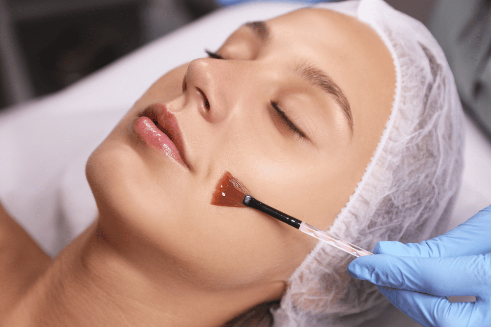 Clínica de Estética em Londrina - Tratamento Facial - Peeling Quimico