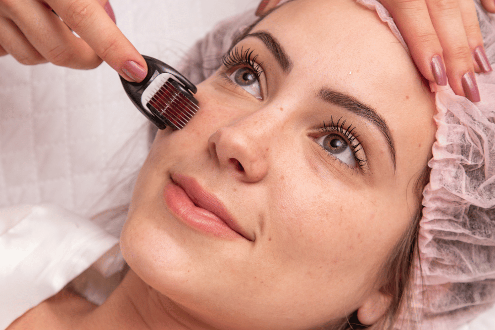 Benefícios do Microagulhamento: Revolução na Beleza Facial