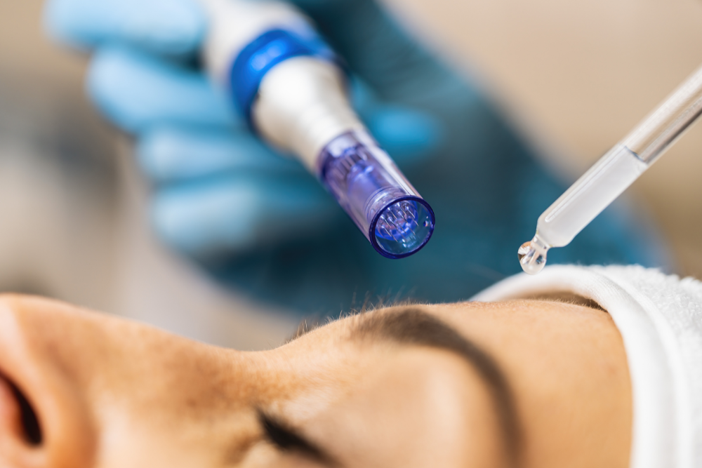 Microagulhamento: Diga Adeus às Manchas e Transforme Sua Pele na Beauty365