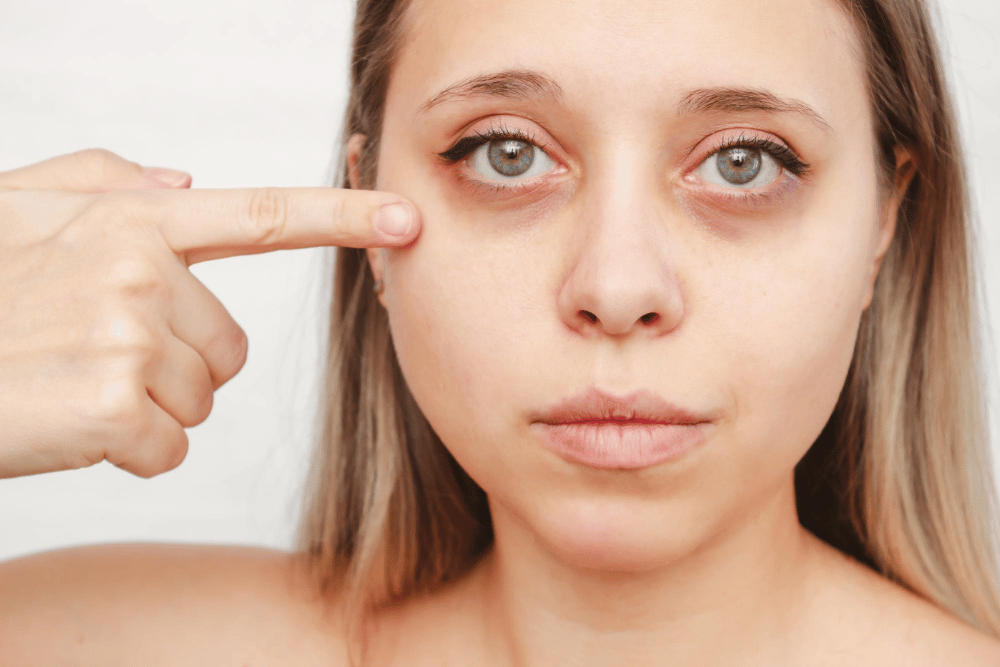 Olheiras: Como Se Livrar Delas e Realçar Sua Beleza com a Beauty365