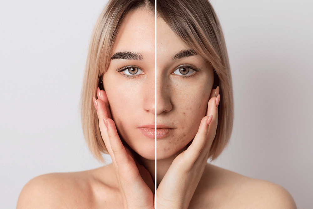 Peeling Químico: Tudo Que Você Precisa Saber