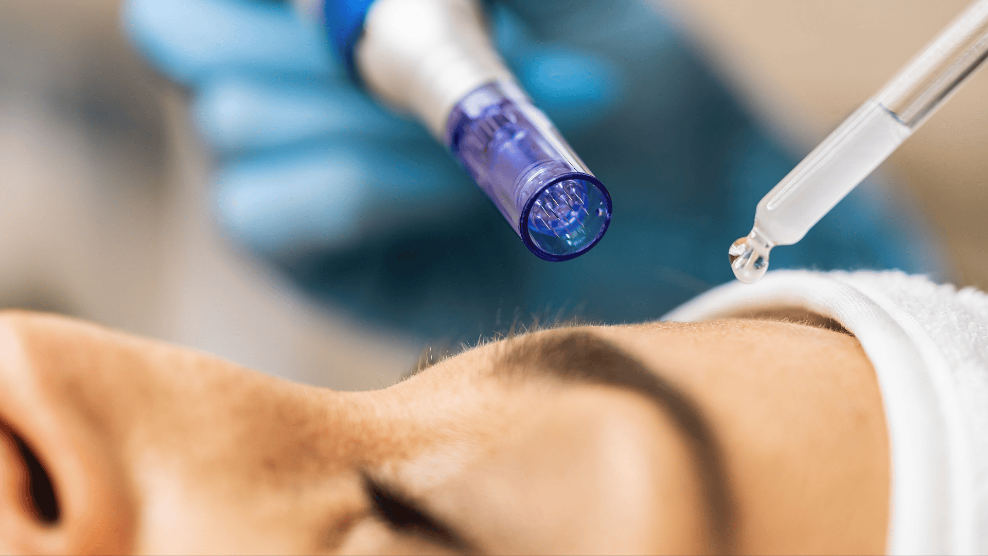 Microagulhamento em Londrina