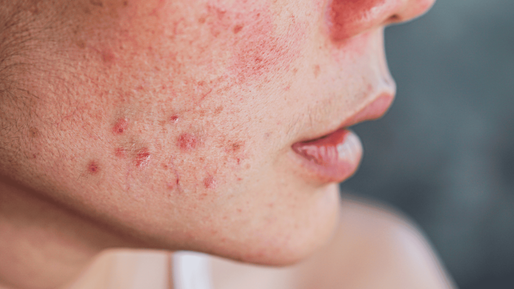 Tratamento para acne em Londrina
