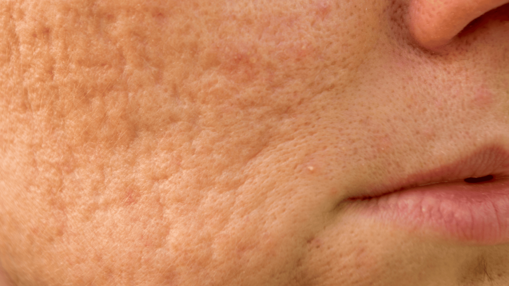 Tratamento para Cicatrizes de Acne em Londrina