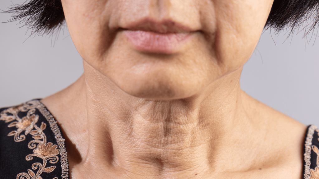Tratamento para Flacidez Facial em Londrina