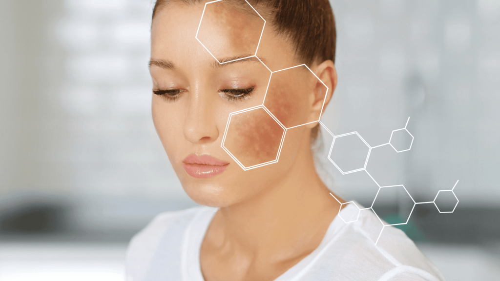 Como tratar melasma: causas, cuidados e tratamentos eficazes