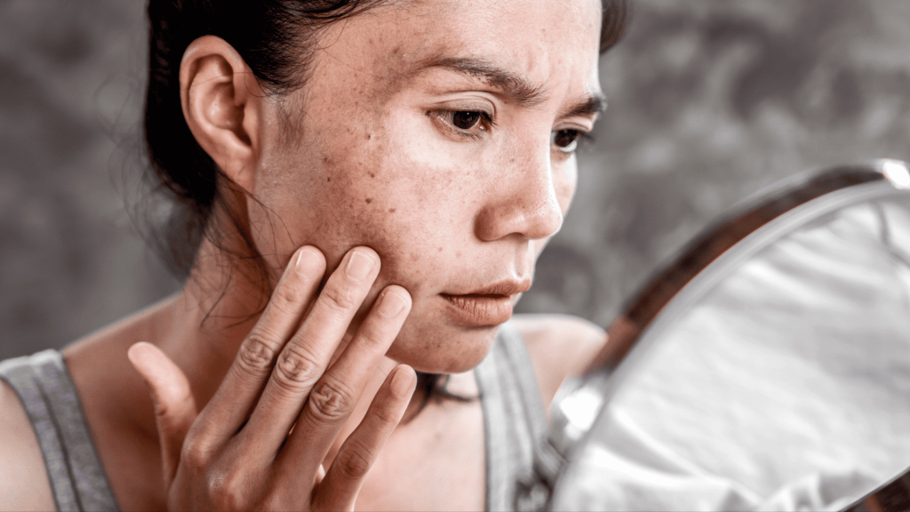 Alimentos que pioram o melasma: saiba o que evitar e como cuidar da sua pele