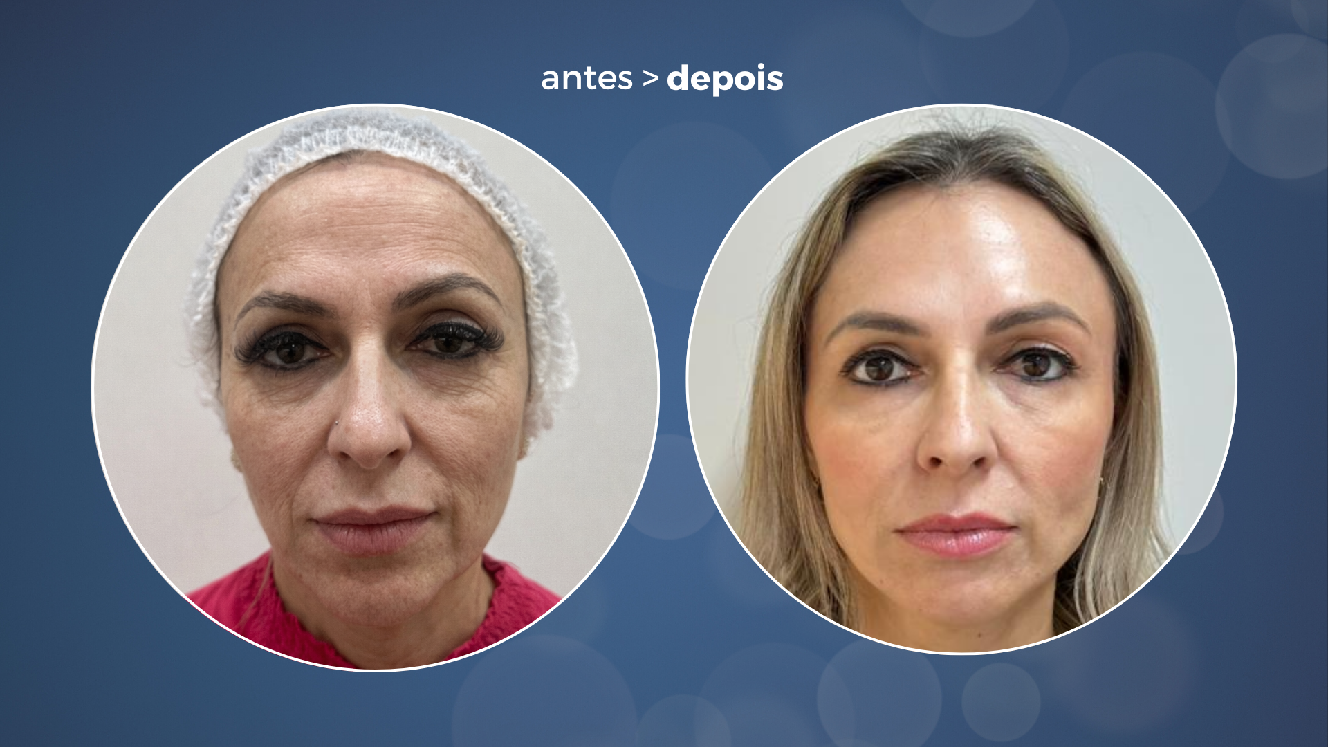 O ultrassom HIFU em Londrina